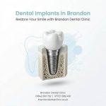 Dental Implants in Brandon – Restore Your Smile at Brandon Dental Clinic